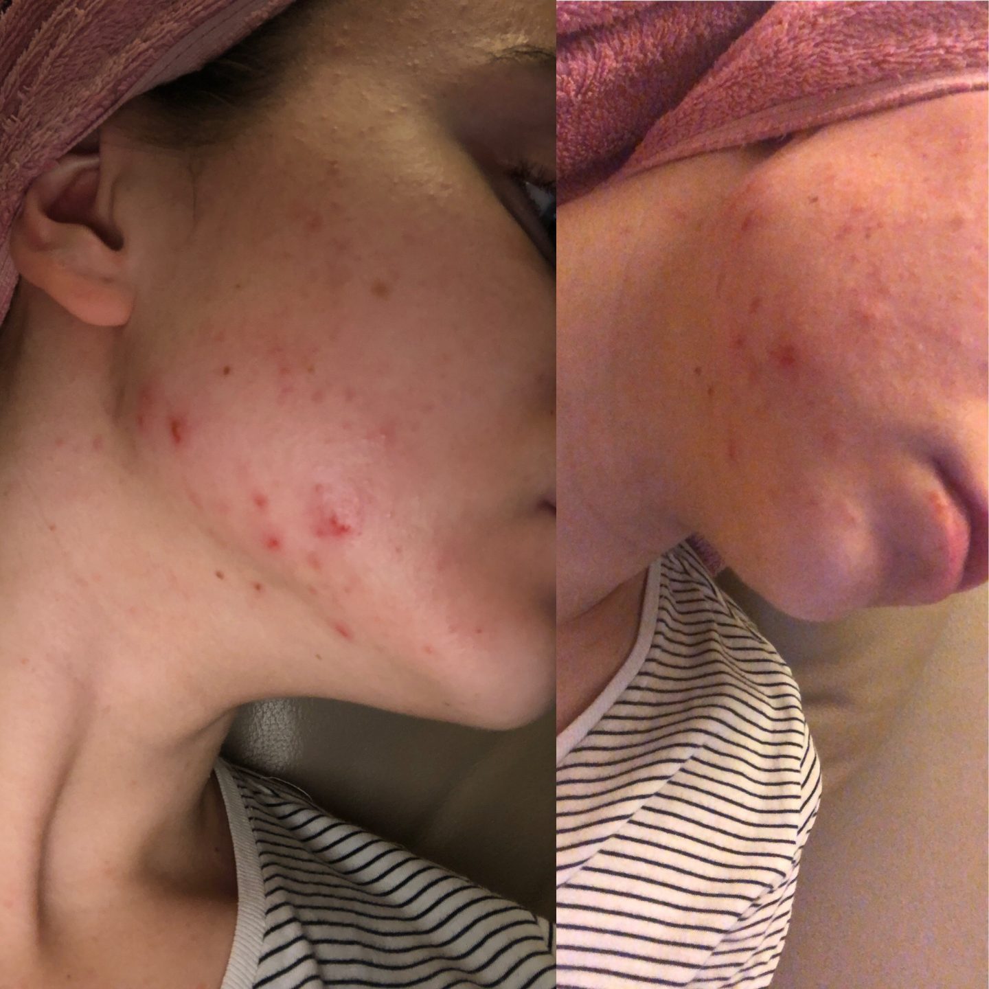 acne in september